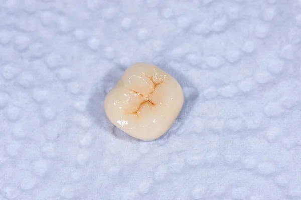 Ceramic-metal crown of a human tooth molar. Macro closeup. Denta — 스톡 사진