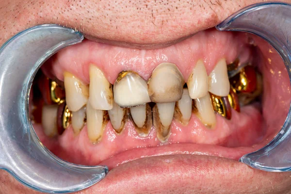 Plaque du patient, pierre. Traitement dentaire de la plaque dentaire — Photo