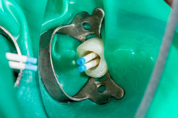 Endodontische behandeling van tanden close-up. Reinigen van de wortels van — Stockfoto