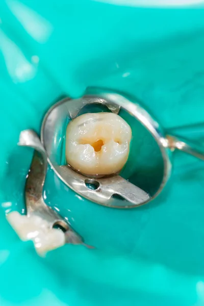 Два жувальні бічні зуби верхньої щелепи після лікування коктейлю — стокове фото