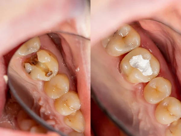 Dişlerin yakın çekimde endodontik tedavisi. Köklerin temizlenmesi — Stok fotoğraf