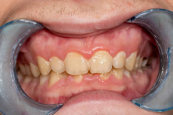 Cáries e doenças dentárias. Enchimento com um fótopo composto dental — Fotografia de Stock