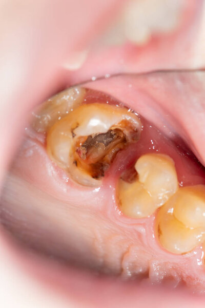Dental caries. Filling with dental composite photopolymer material using rabbders. The concept of dental treatment in a dental clinic
