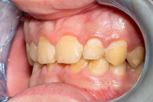 Zubní Kaz Naplnění Stomatologickým Kompozitním Fotopolymerovým Materiálem Použití Králíků Koncept Royalty Free Stock Obrázky