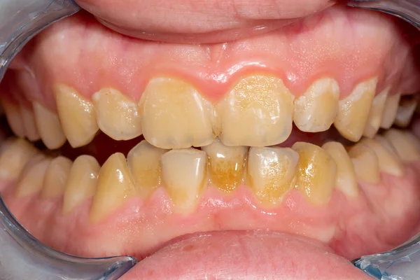 Tatarská Detail Přední Řezáky Dolní Čelisti Dentální Hygiena Zubů Stock Obrázky