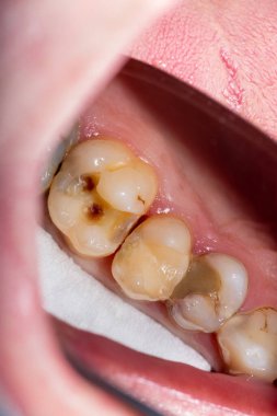 Diş bakımı. Haham kullanarak diş kompozit fotopolimer materyaliyle dolduruluyor. Diş sağlığı kliniğinde diş tedavisi kavramı