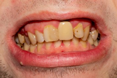 Kötü diş hijyeni. Sigara içtikten sonra diş fırçalamamaya başlayan dişler.