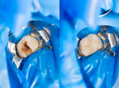 Diş bakımı. Haham kullanarak diş kompozit fotopolimer materyaliyle dolduruluyor. Diş sağlığı kliniğinde diş tedavisi kavramı