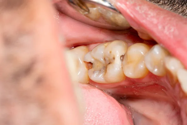 Decaimento Dente Tratamento Com Enchimento Subsequente Com Material Fotopolímero Close — Fotografia de Stock