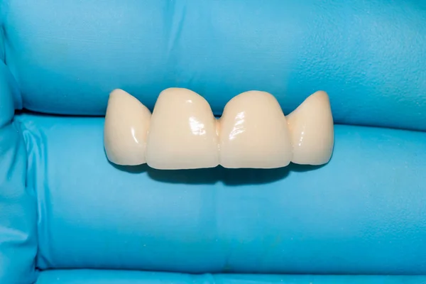 ceramic denture. Ceramic-metal bridge of human teeth in the hands of dentist in blue gloves. Close-up. Macro.