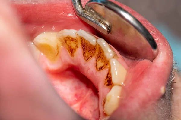 Dålig Tandhygien Plack Tänder Efter Rökning Cigaretter Och Inte Observera — Stockfoto