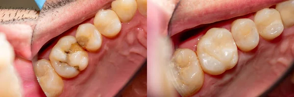 Diş Bakımı Haham Kullanarak Diş Kompozit Fotopolimer Materyaliyle Dolduruluyor Diş — Stok fotoğraf