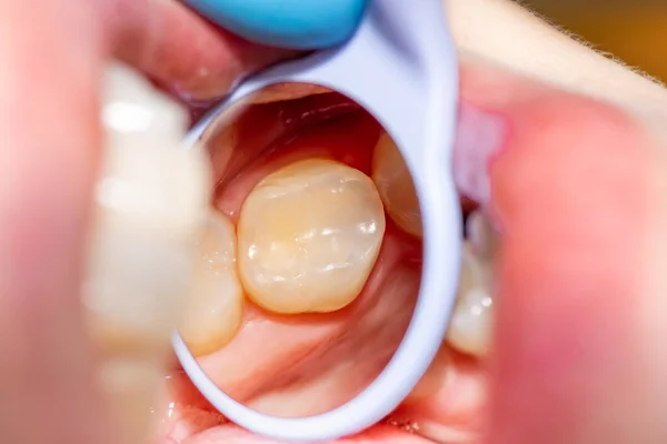 Tratamento Perto Dente Humano Usando Sistema Rabberdam Azul Espelho Dental — Fotografia de Stock