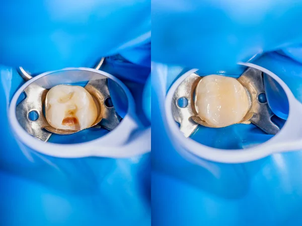 Dental caries. Filling with dental composite photopolymer material using rabbders. The concept of dental treatment in dental clinic