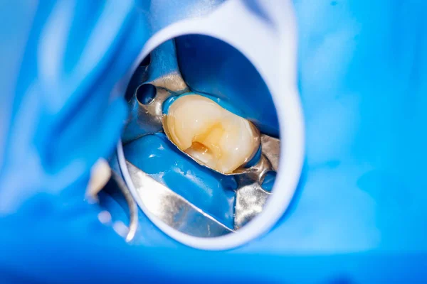 Close Treatment Human Tooth Using Blue Rabberdam System Dental Mirror — Stock Photo, Image