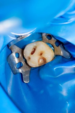 Mavi haham barajı sistemi ve diş aynası kullanarak insan dişine yakın çekim. Estetik dişçilik, hijyen