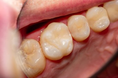 treatment tooth decay with subsequent filling with photopolymer material. Close-up, macro clipart
