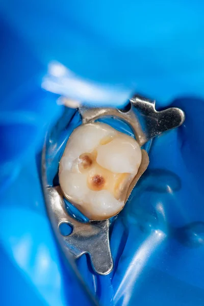 歯のケアだ ラバーを使用して歯科複合光高分子材料で充填します 歯科医院における歯科治療の概念 — ストック写真