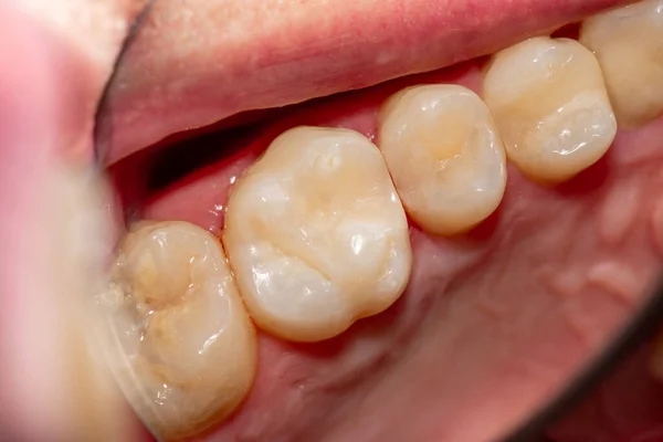 Zubní Kaz Následnou Náplní Fotopolymerovým Materiálem Detailní Záběr Makro Stock Fotografie