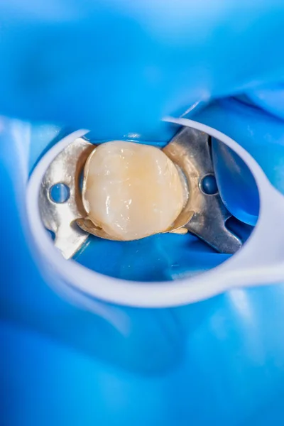 Detailní Záběr Lidský Zub Použitím Modrého Rabberdamského Systému Zubního Zrcátka Royalty Free Stock Fotografie