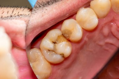 Daha sonra fotopolimer maddeyle doldurulan diş çürümesi tedavisi. Yakın çekim, makro