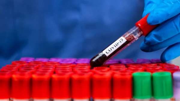 Laboratuvarda Covid-19 'u elle kontrol et.