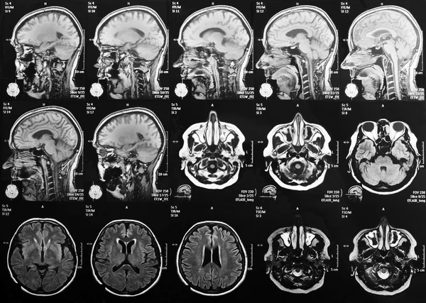 Cabeza y cerebro de rayos X — Foto de Stock