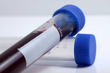 Laboratuvarda analiz ve test için hastadan alınan kan örneği test tüpüne konuldu.