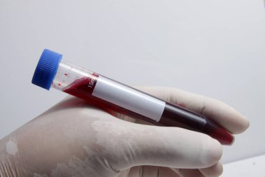 Laboratuvarda analiz ve test için hastadan alınan kan örneği test tüpüne konuldu.