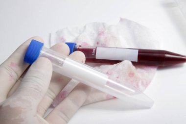 Laboratuvarda analiz ve test için hastadan alınan kan örneği test tüpüne konuldu.