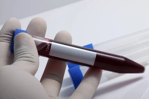 Próbka Krwi Pacjenta Umieszczona Probówce Analizy Badania Laboratorium — Zdjęcie stockowe