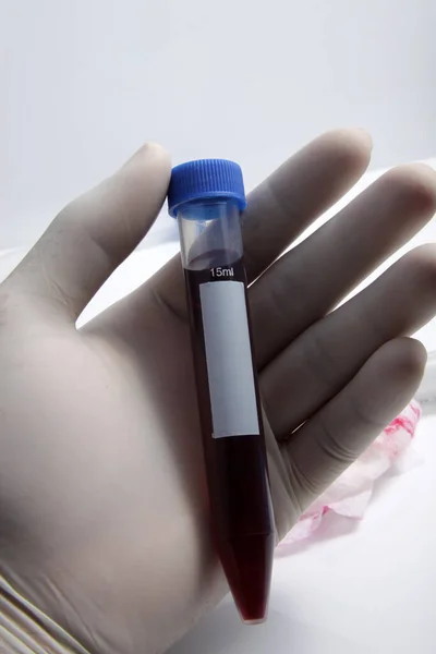 Campione Sangue Del Paziente Inserito Nella Provetta Analisi Test Laboratorio — Foto Stock