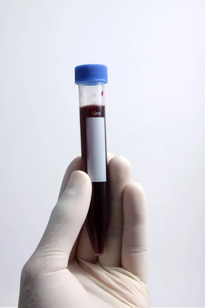 Campione Sangue Del Paziente Inserito Nella Provetta Analisi Test Laboratorio — Foto Stock