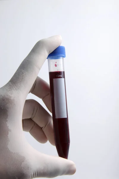 Laboratóriumi Vizsgálat Vizsgálat Céljából Kémcsőbe Helyezett Betegből Vett Vérminta — Stock Fotó
