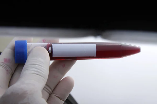 Próbka Krwi Pacjenta Umieszczona Probówce Analizy Badania Laboratorium — Zdjęcie stockowe