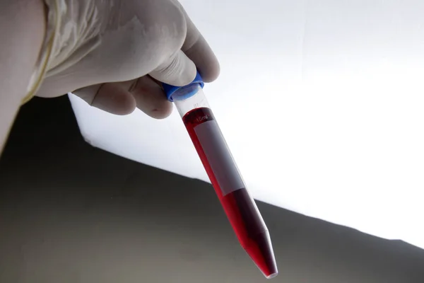 Laboratóriumi Vizsgálat Vizsgálat Céljából Kémcsőbe Helyezett Betegből Vett Vérminta — Stock Fotó