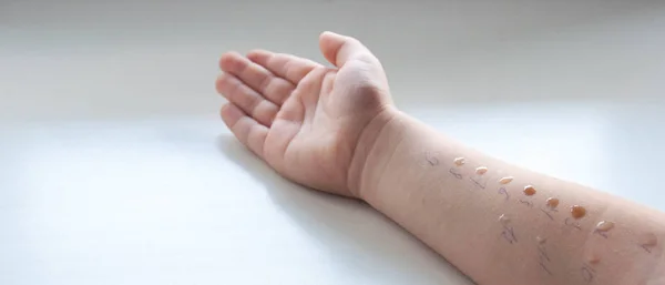 Pediatric Allergy Skin Test Child Hand — Stock Photo, Image