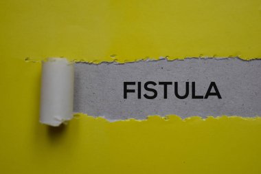 Fistula Text written in torn paper. Medical concept clipart