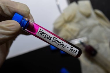 Herpes Simplex - Kan örneği ile test edin. Ofis masasında izole üst görünüm. Sağlık / Tıp kavramı
