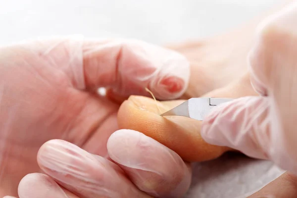Clip fibbia Fissaggio di un morsetto a un'unghia incarnita del piede . — Foto Stock