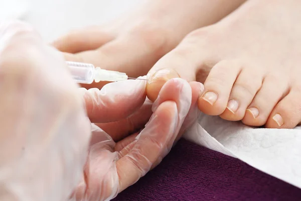 Surgical removal of ingrown nail. — Stock Photo, Image