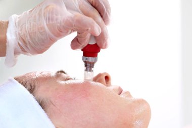 Mezoterapi microneedle, Şevval Özçelik Güzellik kadın