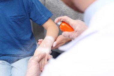 Soothing dressing, first aid for burnsThe doctor puts the foam on the child's burned hand clipart