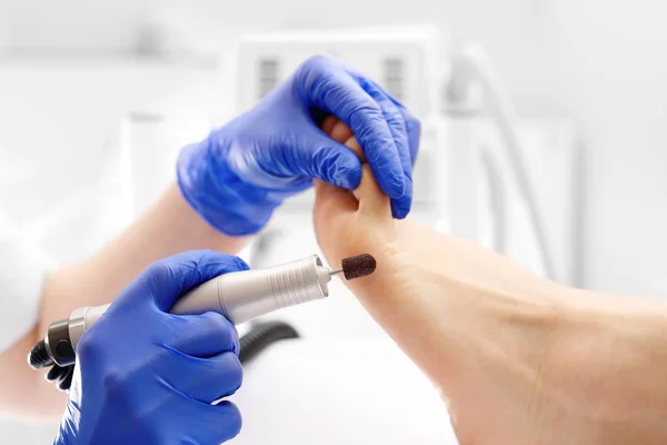 Pedicure. Removal of corns and callus using a milling machine.