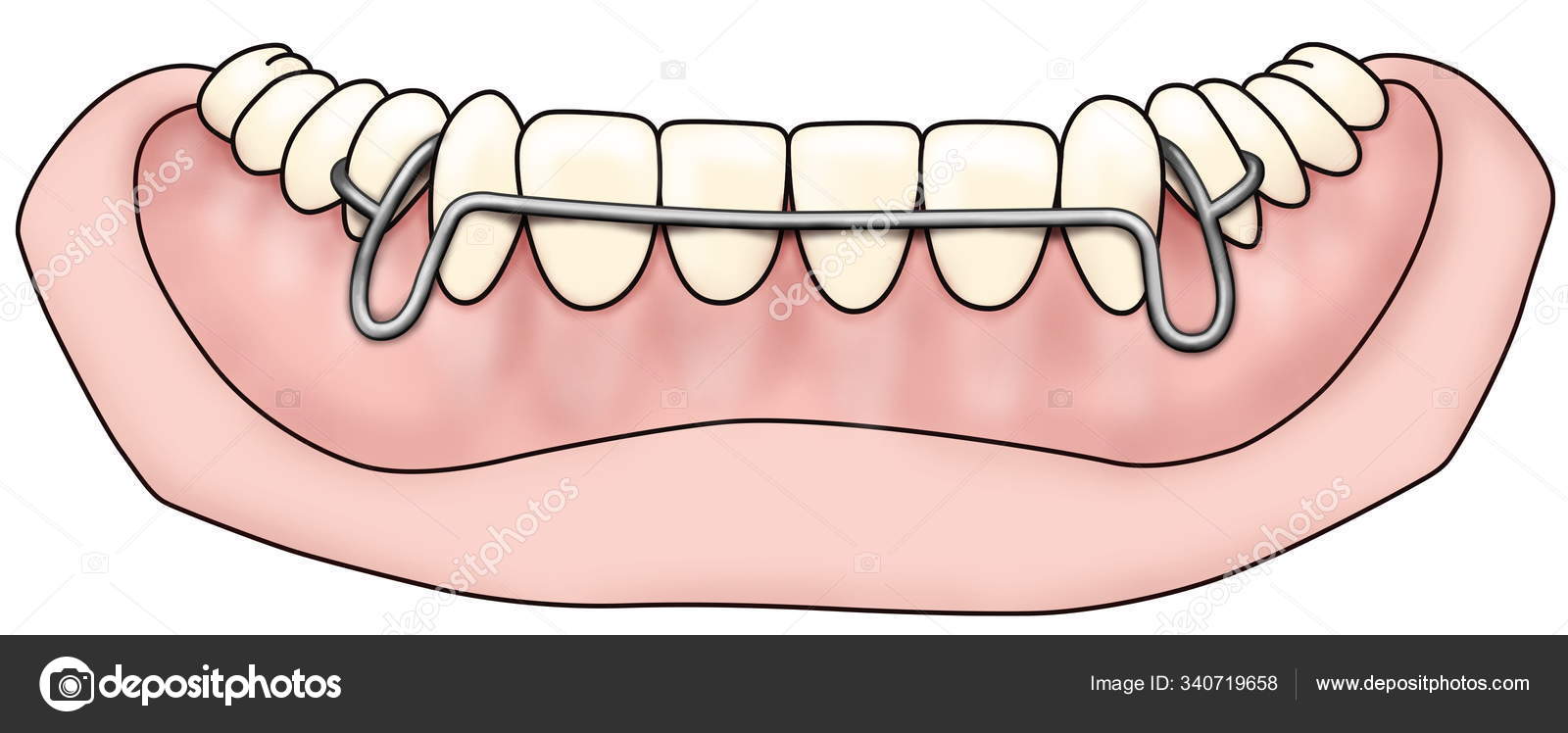 Removable orthodontic appliance is used after orthodontic treatment for