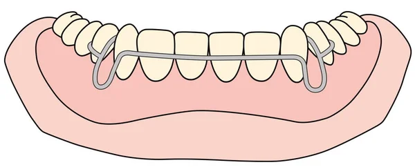 Zdejmowane urządzenie ortodontyczne stosuje się po zabiegu ortodontycznym w celu zatrzymania — Zdjęcie stockowe