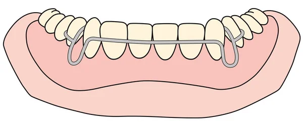 Removable orthodontic appliance is used after orthodontic treatment for retention — 스톡 사진