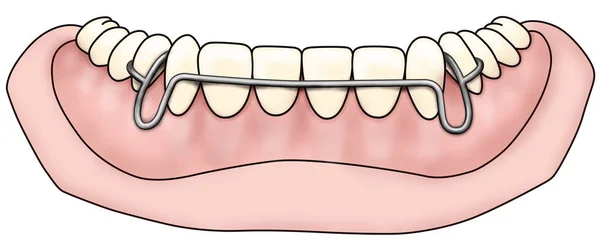 取り外し可能な歯列矯正器具は、保持のための歯列矯正治療後に使用されます — ストック写真
