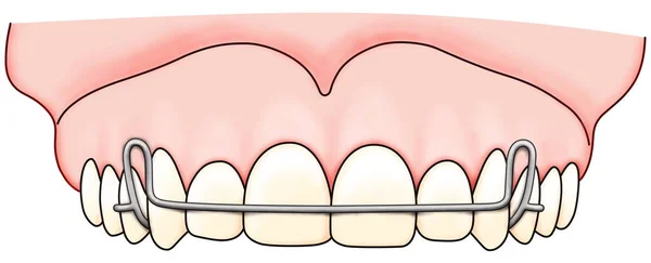 L'apparecchio ortodontico rimovibile viene utilizzato dopo il trattamento ortodontico per la ritenzione — Foto Stock