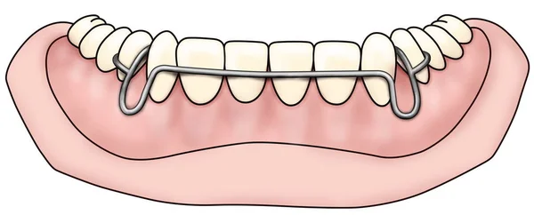 Herausnehmbare kieferorthopädische Apparatur wird nach kieferorthopädischer Behandlung zur Retention verwendet — Stockfoto